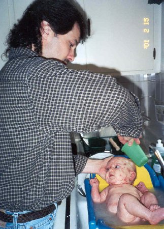 chicken pox baby - feb 15, 2001